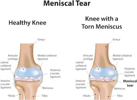Will a Knee Brace Help a Torn Meniscus