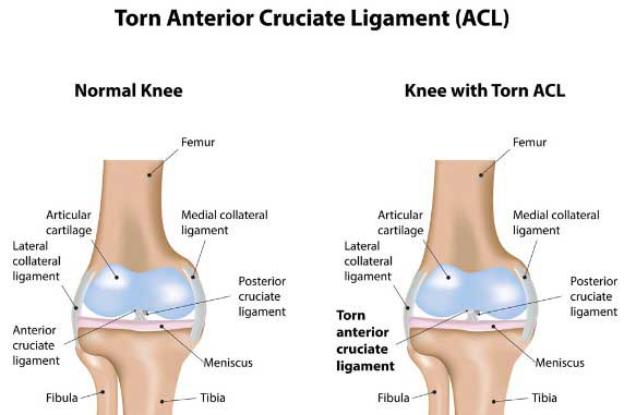 Normal-Knee-and-Knee-with-Torn-ACL What Is a Torn ACL